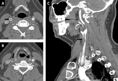 Carotid free.